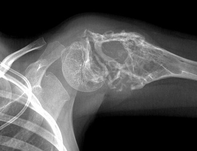 Sarcoma di Ewing cos’è? E come trattarlo